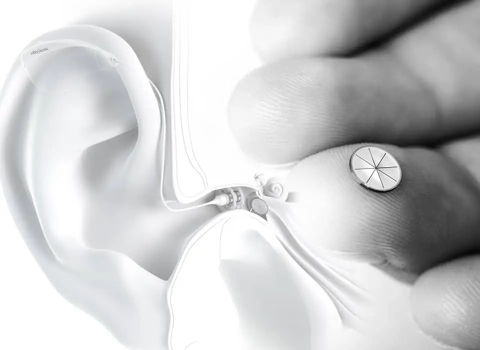 The latest hearing aids can be applied directly to the eardrum, similar to a contact lens for the eye.